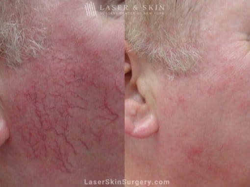 Vascular laser used to treat visible vessels on the cheek