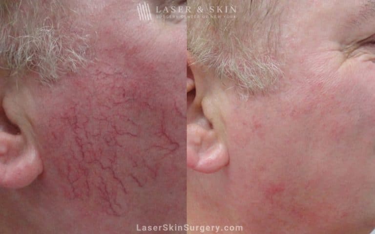 Vascular laser used to treat visible vessels on the cheek