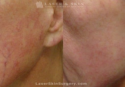 Laser Treatment for Broken or Enlarged Blood Vessels on the Cheek