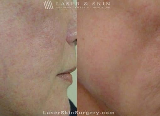 Laser Treatment for Broken or Enlarged Blood Vessels on the Cheek