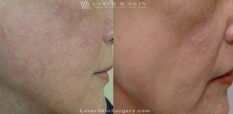 before and after image of a laser treatment for broken blood vessels on a woman's cheek