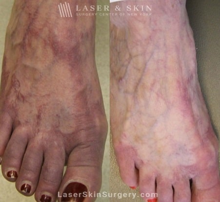 before and after image of a laser treatment for Broken or enlarged blood vessels on a foot