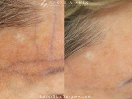 Vascular laser to treat broken or enlarged blood vessels on the forehead