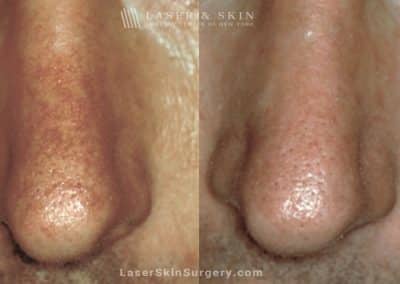 Laser Treatment for Broken or Enlarged Blood Vessels on a Man’s Nose