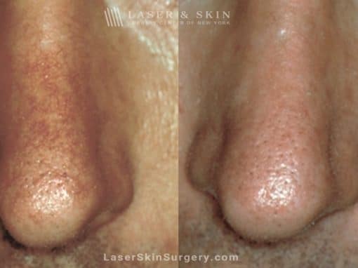 Laser Treatment for Broken or Enlarged Blood Vessels on a Man’s Nose