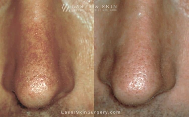 before and after image of a laser treatment for Broken or enlarged blood vessels on a man's nose