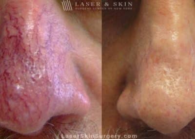 Vascular laser to treat broken or enlarged blood vessels on patient’s nose