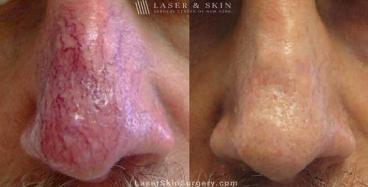 before and after image of a laser treatment for Broken or enlarged blood vessels on a man's nose