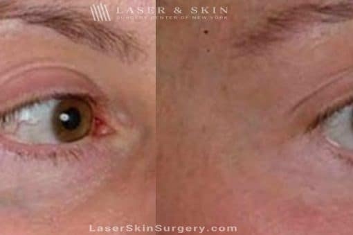 Laser Treatment for Broken or Enlarged Blood Vessels Under the Eye