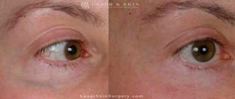 before and after image of a laser treatment for enlarged blood vessels on the face