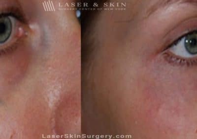 Laser Treatment for Broken or Enlarged Blood Vessels Under the Eye
