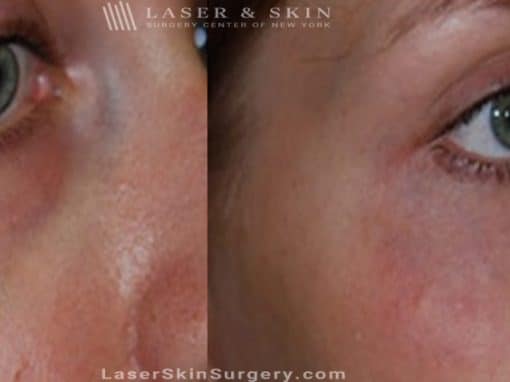 Laser Treatment for Broken or Enlarged Blood Vessels Under the Eye