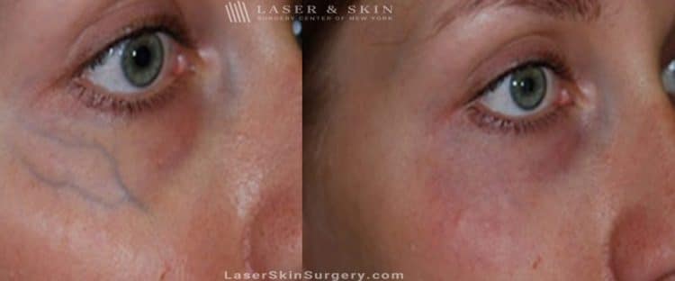 before and after image of a laser treatment for enlarged blood vessels under a woman's eye