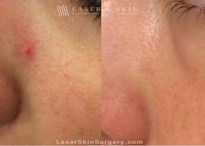 Laser Treatment for Broken or Enlarged Blood Vessels Under the Eye