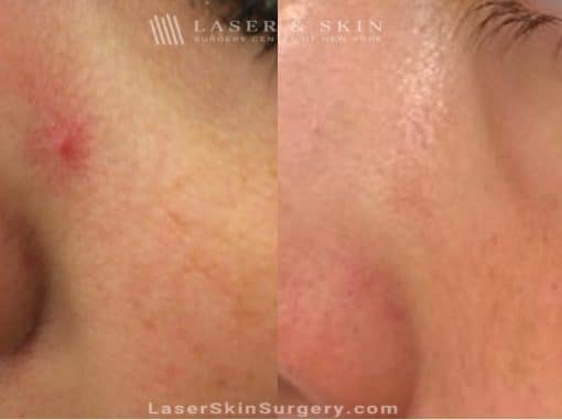 Laser Treatment for Broken or Enlarged Blood Vessels Under the Eye