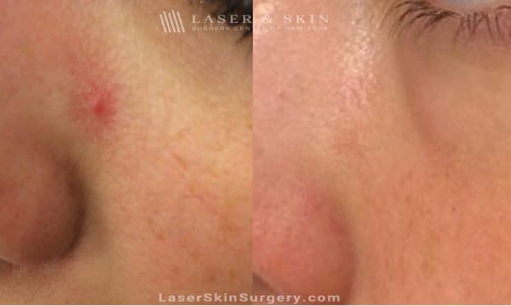 laser-treatment-for-facial-broken-blood-vessels-nyc-4587 spider veins removal in new york before and after