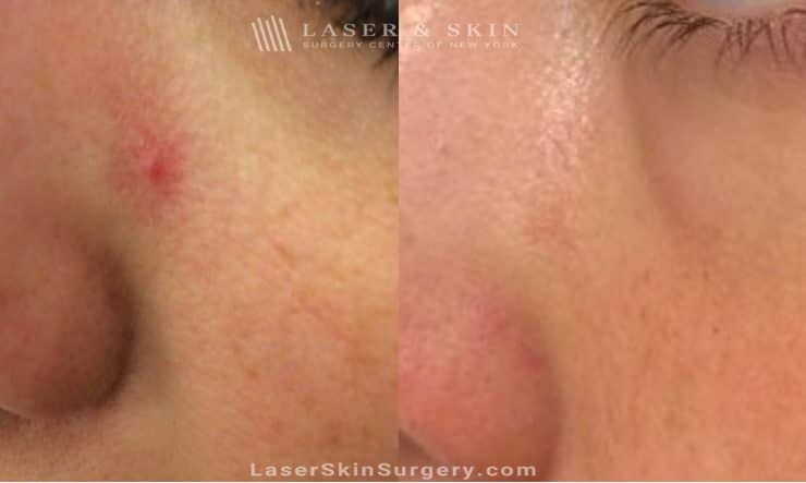 spider veins removal in new york before and after