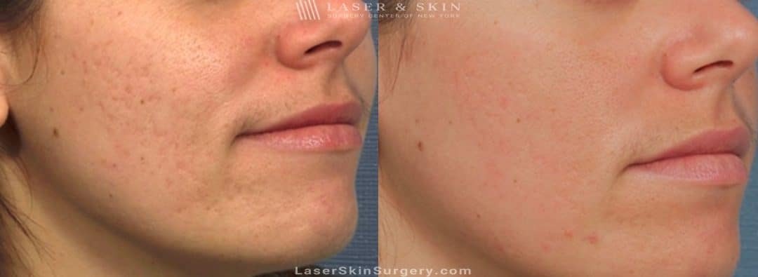 image of a before and after for laser treatment to remove a scar on the cheek