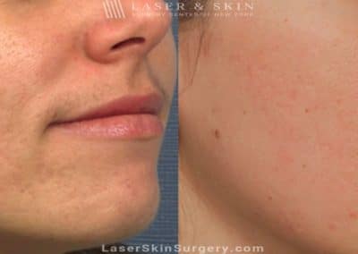 Laser Treatment to Remove Facial Scarring