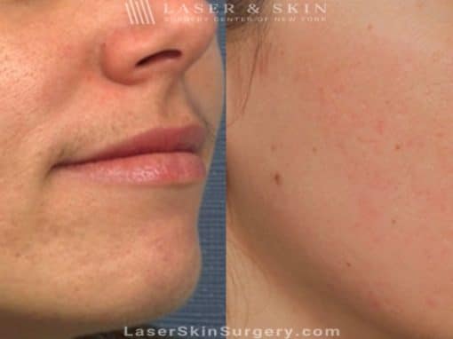 Laser Treatment to Remove Facial Scarring