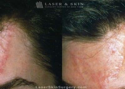 Laser Treatment to Remove a Scar on the Forehead