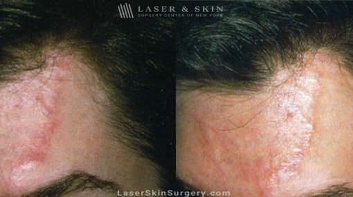 Laser Treatment to Remove a Scar on the Forehead