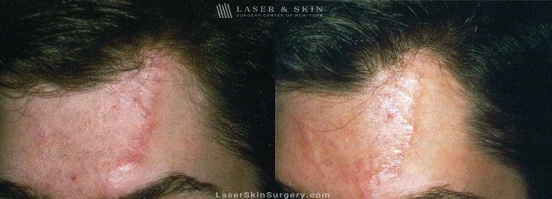 image of a before and after for laser treatment to remove a scar on a man's forehead