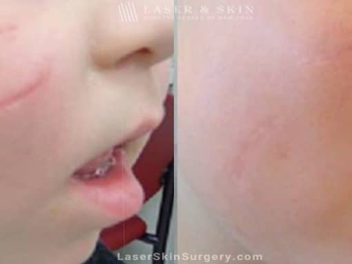 Laser Treatment to Remove a Scar on a Child’s Face