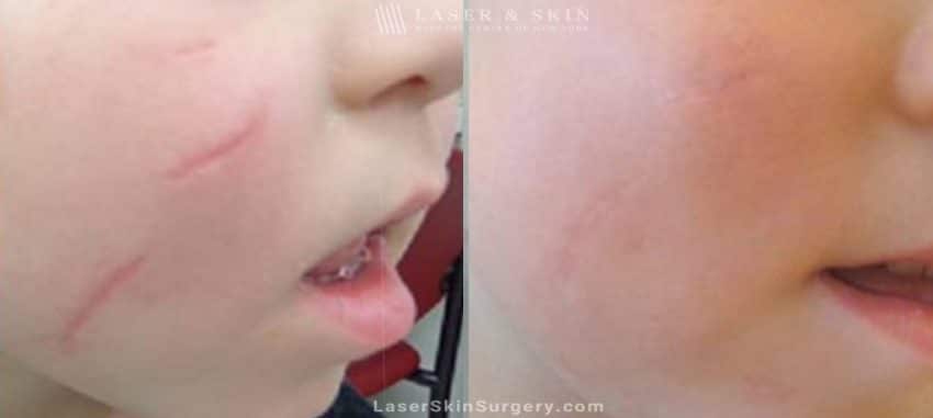 image of a before and after for laser treatment to remove a scar on a little boy's cheek