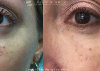 Laser Treatment for Scar Removal Under the Eye