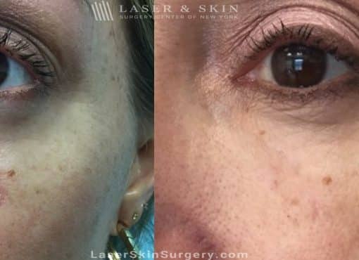 Laser Treatment for Scar Removal Under the Eye