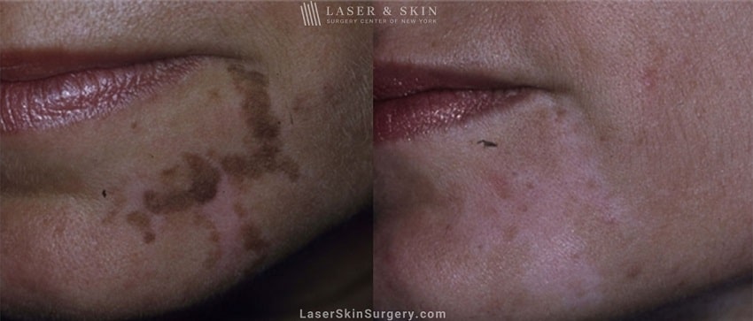 image of a before and after laser treatment to remove nevus of ota skin pigmentation on the chin of a woman