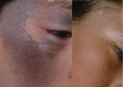 Laser Treatment for Nevus of Ota Around the Eye