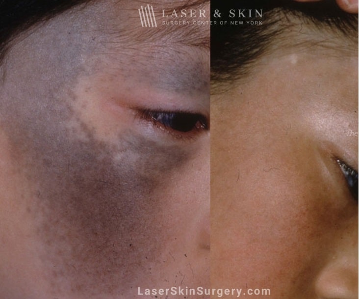 image of a before and after laser treatment to remove nevus of ota skin pigmentation on the side of the face