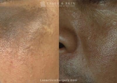 Laser Treatment for Nevus of Ota