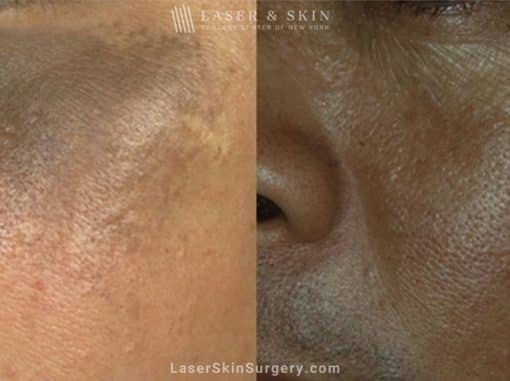 Laser Treatment for Nevus of Ota