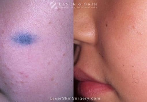 Laser Treatment for Nevus of Ota