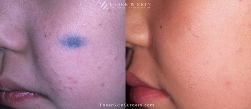 image of a before and after laser treatment to remove nevus of ota skin pigmentation near the nose of a child