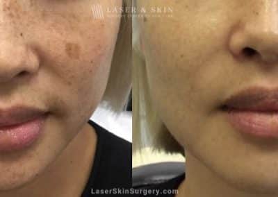Laser Treatment for Facial Brown Spots/Sun Damage