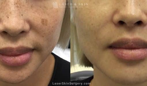 Laser Treatment for Facial Brown Spots/Sun Damage