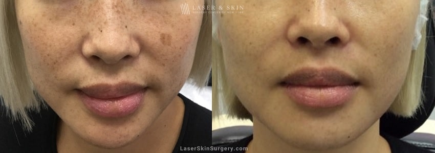 before and after image of a laser treatment to remove facial sun damage