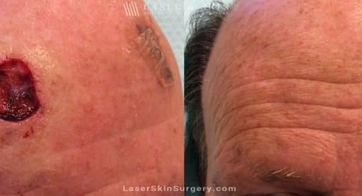 Mohs Micrographic Surgery for the Removal of Skin Cancer on the Forehead