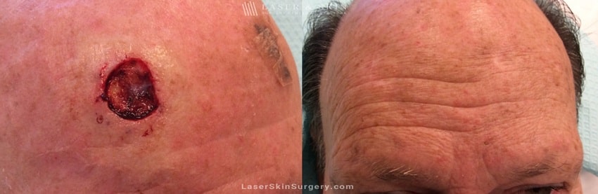 before and after image of mohs surgery for the removal of skin cancer on the top of a man's forehead