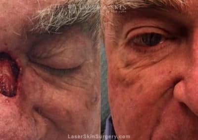 Mohs Micrographic Surgery for the Removal of Skin Cancer