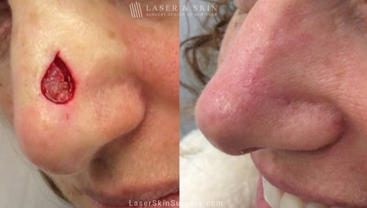 before and after image of mohs surgery for the removal of skin cancer on the side of a woman's nose