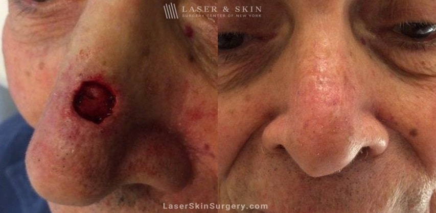 before and after image of mohs surgery for the removal of skin cancer on the side of a man's nose