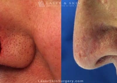 Mohs Micrographic Surgery for the Removal of Skin Cancer on the Side of a Nose