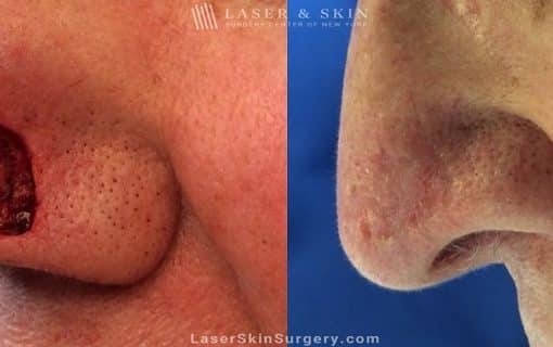 Mohs Micrographic Surgery for the Removal of Skin Cancer on the Side of a Nose