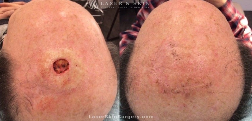 before and after image of mohs surgery for the removal of skin cancer on the top a man's head