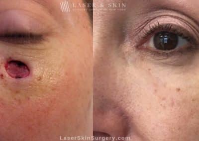 Mohs Micrographic Surgery for the Removal of Skin Cancer Under the Eye